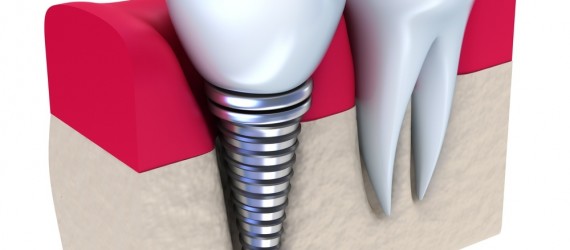 Implant
